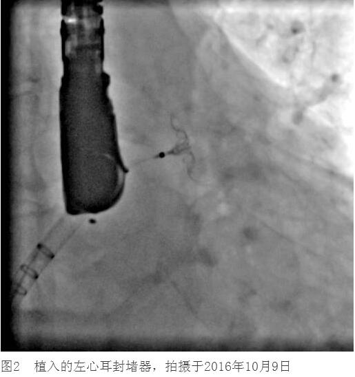 王师傅行经皮左心耳封堵术后6个月 不服用华法林了