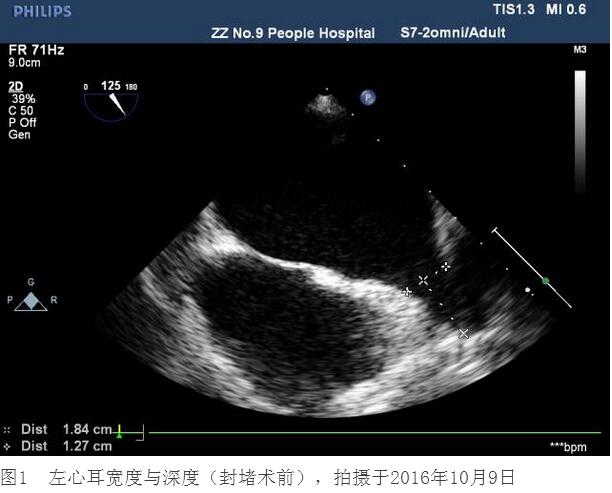 王师傅行经皮左心耳封堵术后6个月 不服用华法林了