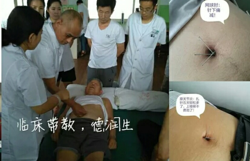 易象脐针疗法传承人——王培根 易象脐针疗法传承人——王培根